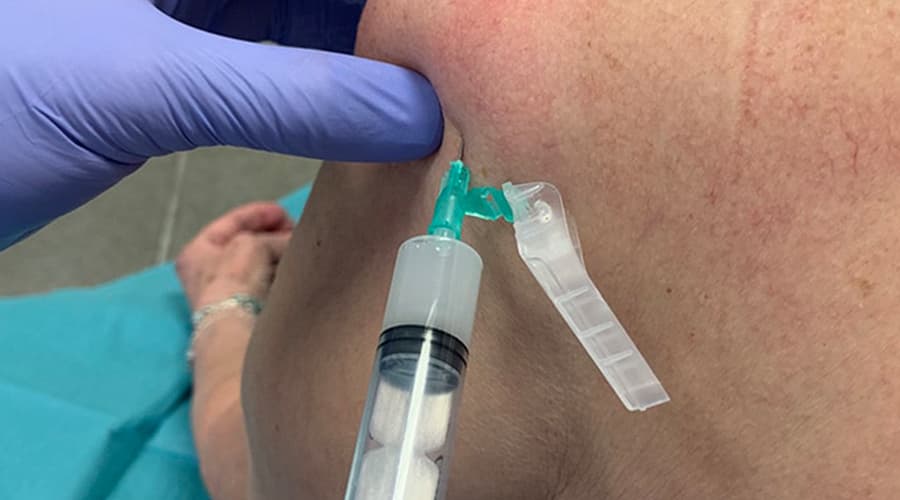 Infiltración en tendinitis