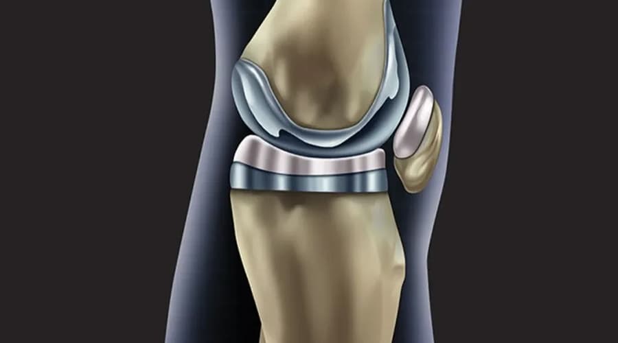 Prótesis total de rodilla